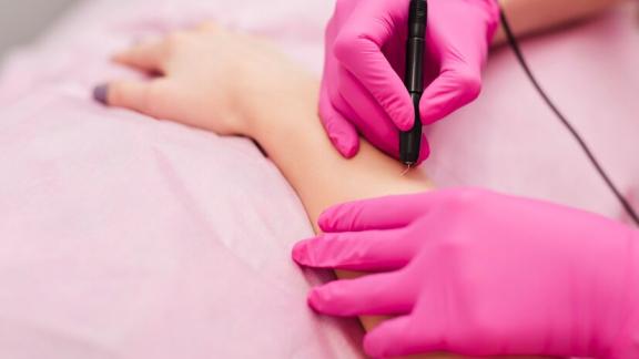 Электроэпиляция. Что это такое, кому подходит, противопоказания