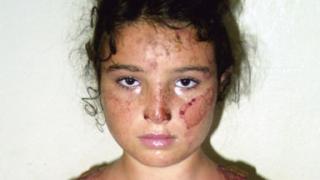 Ожоги у 14-летней девочки – результат соседcкого самосуда