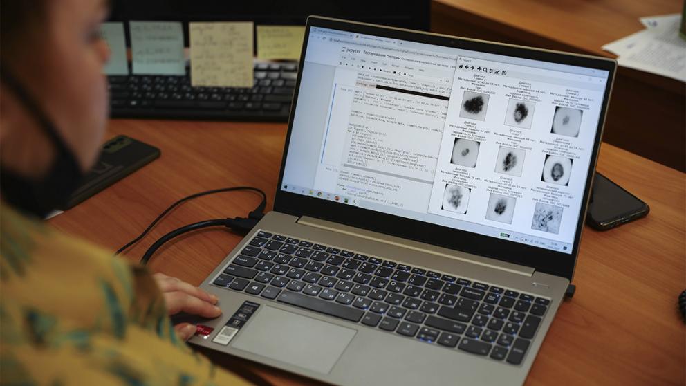 Учёные СКФУ разработали нейросетевую систему распознавания рака кожи