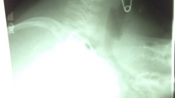 Ставропольцам напомнили об опасности попадания посторонних предметов в дыхательные пути малышей