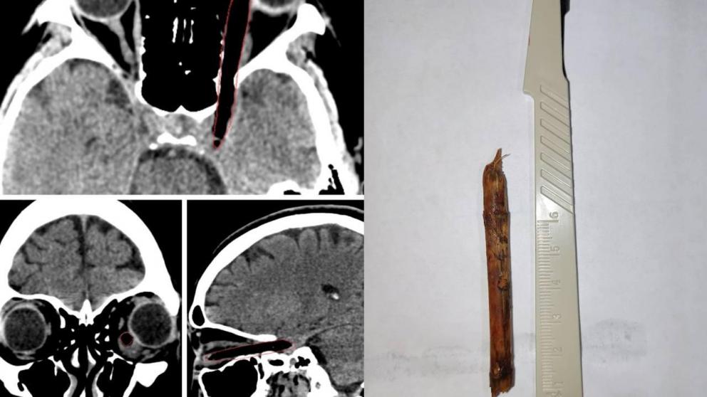 Ставропольские медики удалили из черепа пациентки обломок ветки